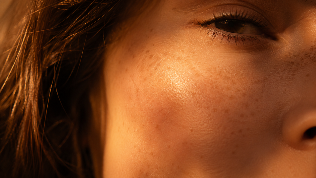 Primer plano de mejilla con pecas y pigmentación en luz dorada, manchas en la piel — Aletheia Skin Lab